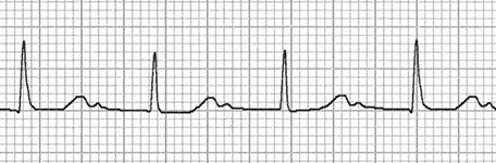 ECG double T waves camel hump and first av block (T wave and P wave)