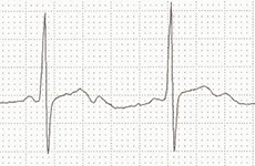 ECG hypokalemia double camel hump T waves (T wave and U wave)