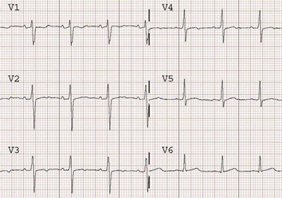 ECG ischaemia flattened T waves