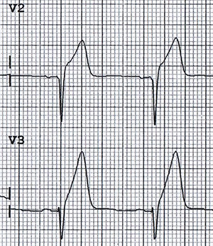 ECG hyperacute T wave with ischaemia - infarction