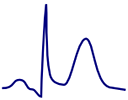 ECG hyperacute t wave, broad asymmetrical peaked