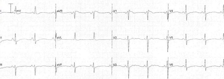 ECG hypokalemia flattened T waves