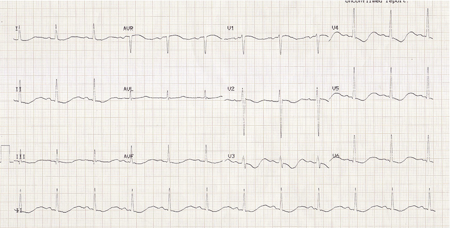 ECG hypokalemia and biphasic T wave terminal positivity