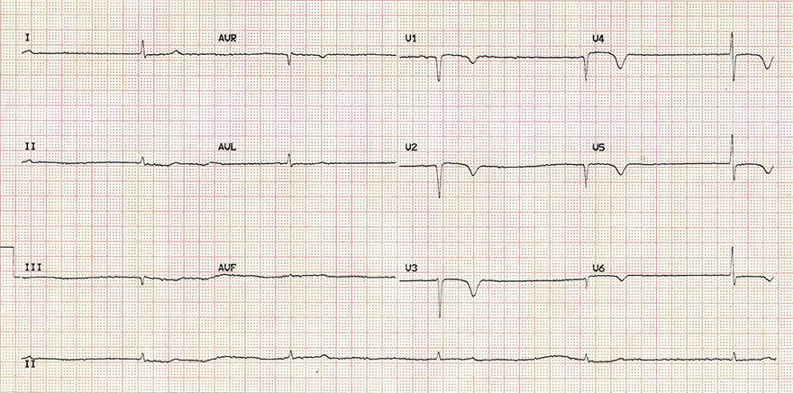 ECG inverted T wave and hypothyroidism