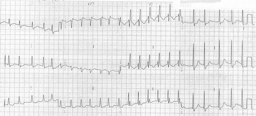 ECG inverted T wave and right bundle branch block (RBBB)