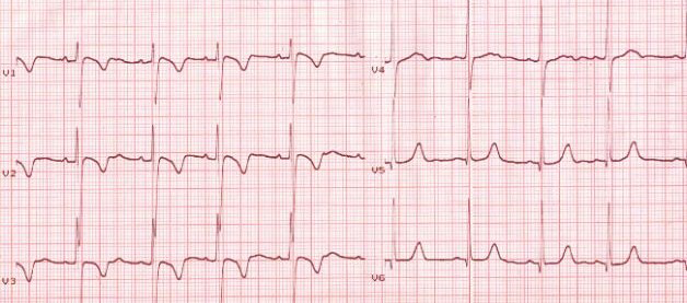 ECG persistent Juvenile T-wave Pattern in young afro caribbean women