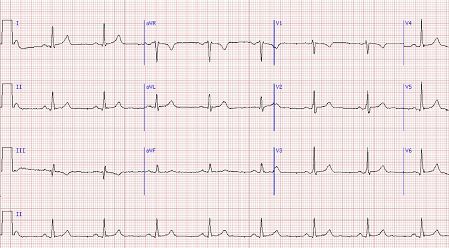 ECG normal T wave and sinus rhythm