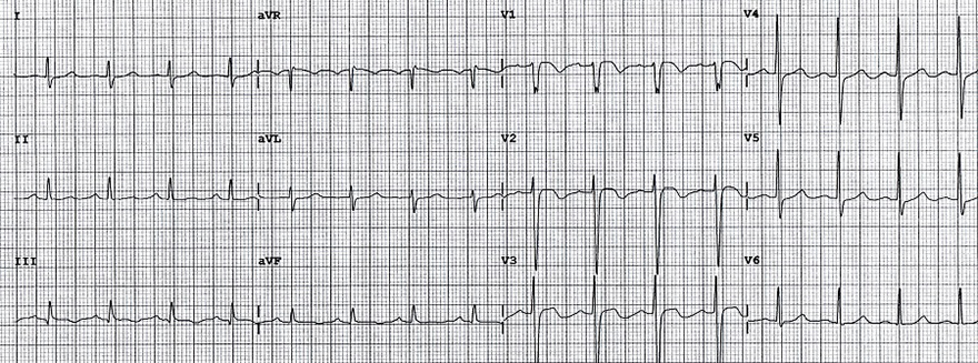 ECG inverted T wave and pulmonary embolism