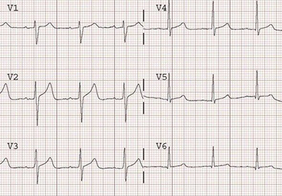 ECG normal T wave after ischaemia with sinus rhythm