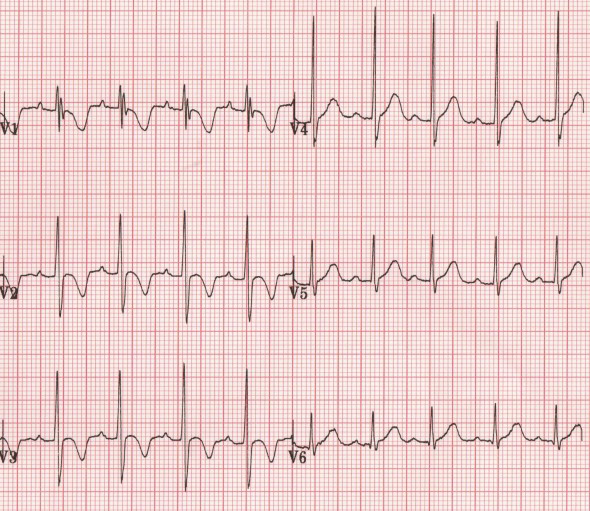 ECG paediatric inverted T waves in 2yr old children boy