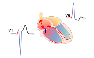 WPW syndrome type B, right-sided accessory pathway (Bundle of Kent)