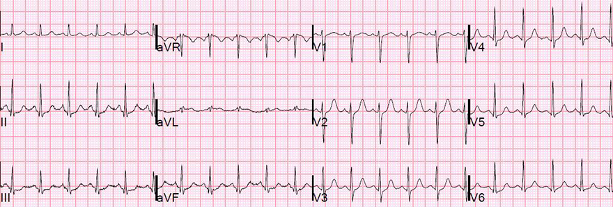 ECG negative Ta wave and sinus tachycardia