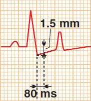 ECG ST segment measurement 80ms after J point and PQ interval