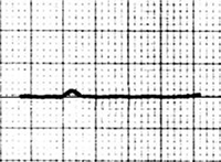 ECG isoelectric ta wave