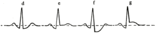 ECG negative Ta wave and measurement ST elevation, ST depression