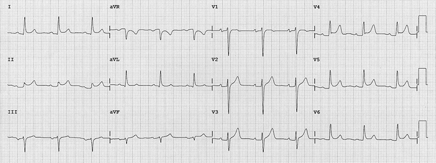 ECG acute pericarditis, concave ST elevation, PQ (PR) depression