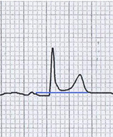 ECG pericarditis vs atrial ischaemia infarction, PQ depression, concave ST elevation