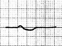 ECG atrial repolarization Ta wave