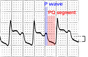 ECG PQ depression P wave and PQ segment measurement