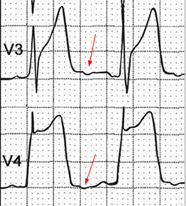 ECG inverted U wave prinzmetal angina pectoris