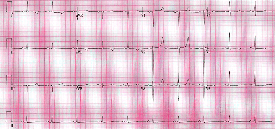 ECG hypocalcaemia and U wave