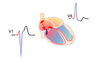 WPW syndrome, type B, right sided accessory pathway