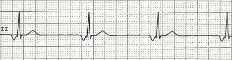 ECG accelerated junctional rhythm, inverted (retrograde) P waves with short PQ (PR) interval