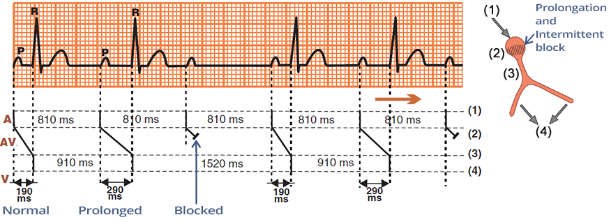 ECG (Ladder diagram - Laddergarm) with second degree AV block (Mobitz I - Wenckebach) with prolonged variable PQ (PR) interval