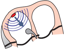 SA node, sinus tachycardia