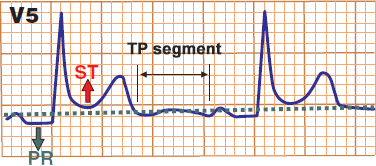 PQ Segment - ECG book