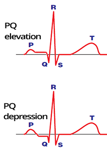 Atrial ischemia (infarction) PR elevation, PR depression. Liu criteria