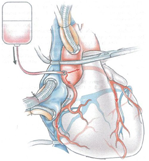 Cardioplegia, temporary cessation of cardiac activity with hyperkalemia, cardioplegic solution