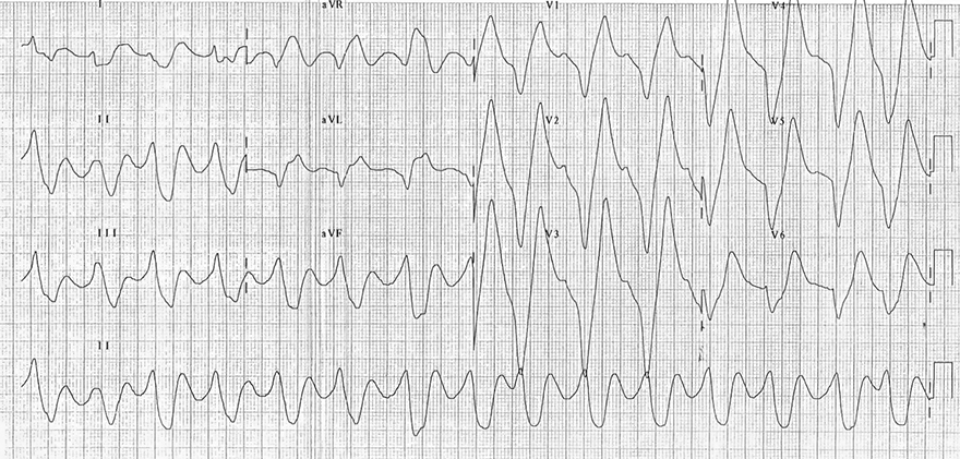 ECG hyperkalemia potassium level 9 mEq/L, peaked T waves - Eiffel tower, prolonged QRS, sine wave