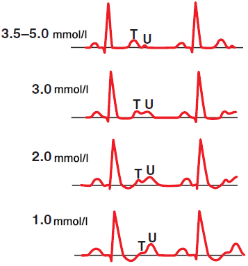 ECG changes with hypokalemia, low potassium level, T wave, U wave