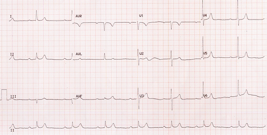 ECG hypermagnesaemia 1,18mmol/l, sinus bradycardia, first degree AV block, long QT interval