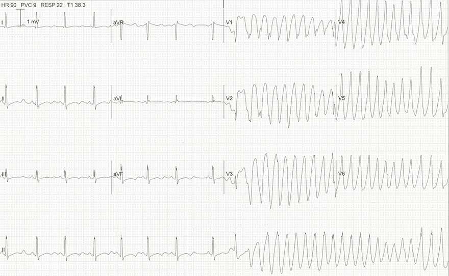 ECG hypomagnesaemia, hypokalemia, long QT interval, U wave, r on t phanomenon, Torsades de Pointes (TdP)