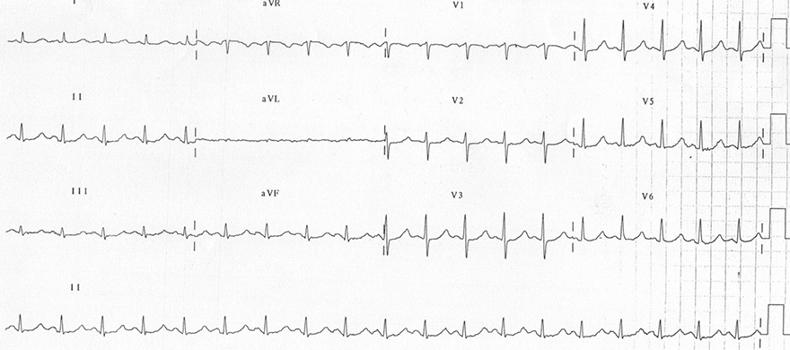 ECG hypomagnesaemia 0,66mmmol/l, sinus tachycardia, prolonged QT interval