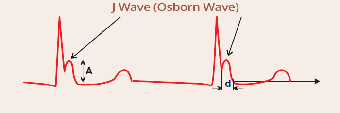 Hypothermia, ECG J wave, Osborn wave duration and amplitude