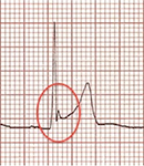 ECG benign early repolarization and J, Osborn wave