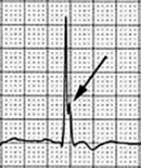 ECG hypercalcemia and J wave as notch