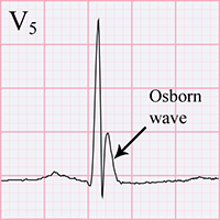 ECG hypothermia Osborn J wave