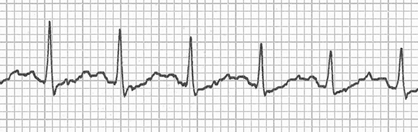 ECG camel hump appearance, hidden P waves in sinus tachycardia