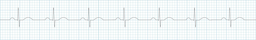 ECG normal sinus rhythm, heart rate 77 bpm