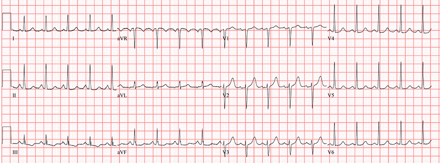 ECG sinus tachycardia, heart rate 120bpm, normal P waves