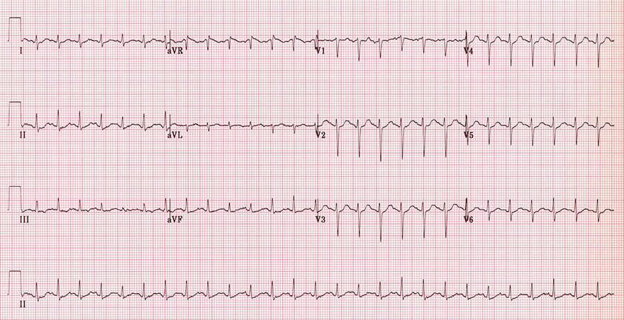 ECG sinus tachycardia, heart rate 150bpm, normal P waves, electrical qrs alternans