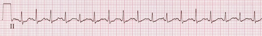 ECG sinus tachycardia