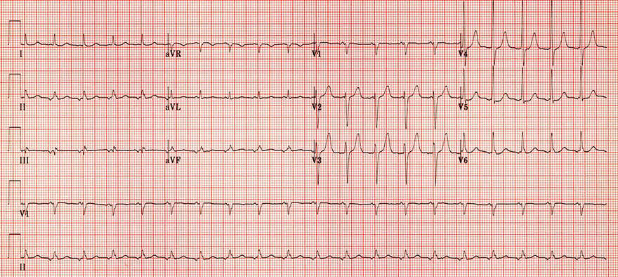 ECG unifocal atrial tachycardia