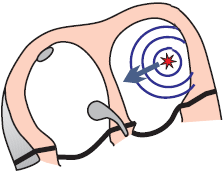 ectopic unifocal focus