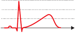 ECG pattern, LQTS1, Congenital Long QT Syndrome