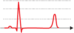 ECG pattern, LQTS3, Congenital Long QT Syndrome